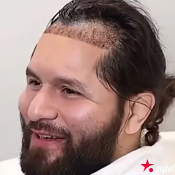 从八角笼到手术台：UFC名将豪尔赫·马斯维达尔赴土耳其植发，大发体育助力你的致富之路！【EV扑克官网】